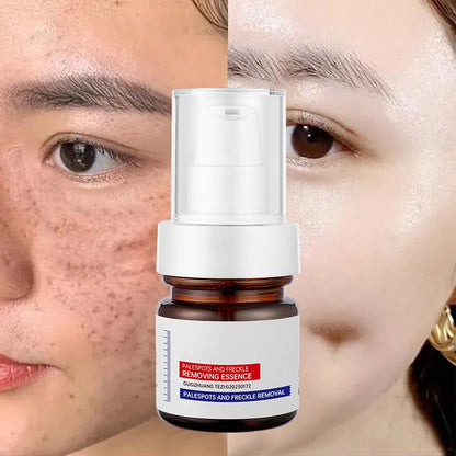 ⚡5-second brightening rescue: Dark spots disappear, blemishes fade, and skin becomes radiant! Vitamin C Whitening Freckles